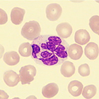 Hypersegmented neutrophil