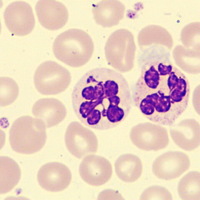 Hypersegmented neutrophil