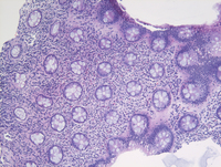 Mastocytosis H&E Low Power