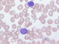 Mycosis Fungoides Blood