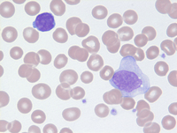 Mycosis Fungoides Blood