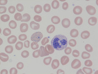 Cabot ring in hemolytic anemia