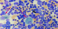 Hemolytic Anemia