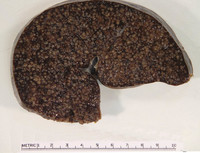 Splenic Marginal Zone Lymphoma-Spleen