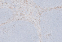Splenic Marginal Zone Lymphoma-CD10