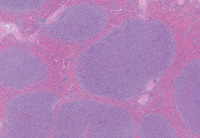 Splenic Marginal Zone Lymphoma-H&E