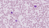 CML-Accelerated Phase-Blood