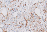 CML-Accelerated Phase-CD34