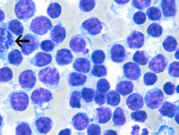 Splenic Marginal Zone Lymphoma-Touch Preparation