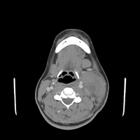 SHML-CT neck