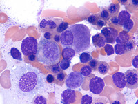 Refractory Cytopenia of Childhood