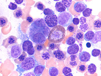 Refractory Cytopenia of Childhood