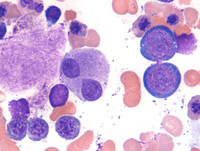 Refractory Cytopenia of Childhood