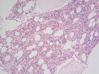 Refractory Cytopenia of Childhood