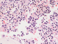 Refractory Cytopenia of Childhood