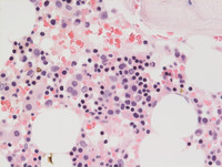 Refractory Cytopenia of Childhood