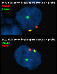 Double Hit Lymphoma-FISH