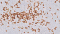 Double Hit Lymphoma-CD3