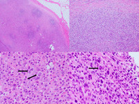 Anaplastic Large Cell Lymphoma ALK+ H&E