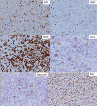 Anaplastic Large Cell Lymphoma ALK+ IHC