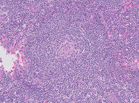 Germinotropic Lymphoproliferative Disorder-H&E