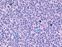 Follicular Lymphoma Grade 3a-H&E