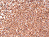 Follicular Lymphoma Grade 3a-BCL2