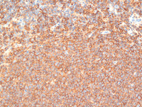 Follicular Lymphoma Grade 3a-CD20