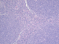 Follicular Lymphoma Grade 3a-H&E