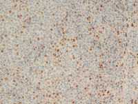 Follicular Lymphoma Grade 3a-LMO2