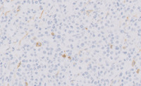 Plasmacytoma-Like PTLD, EBV+ CD56