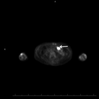 Plasmacytoma-Like PTLD, EBV+ Pet Scan