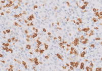 Plasmacytoma-Like PTLD, EBV+ CD3