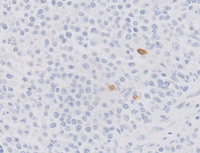 Plasmacytoma-Like PTLD, EBV+ CD20