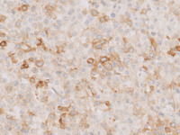 Plasmacytoma-Like PTLD, EBV+ CD30