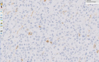 Plasmacytoma-Like PTLD, EBV+ CD56