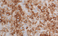 Plasmacytoma-Like PTLD, EBV+ CD79a