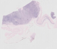 Plasmacytoma-Like PTLD, EBV+ EBER