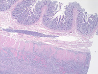 Plasmacytoma-Like PTLD, EBV+ H&E Low Power