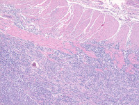 Plasmacytoma-Like PTLD, EBV+ H&E Low Power