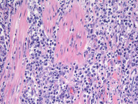 Plasmacytoma-Like PTLD, EBV+ H&E High Power