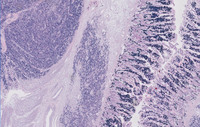 Plasmacytoma-Like PTLD, EBV+ Kappa