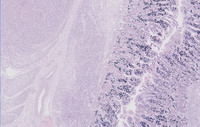 Plasmacytoma-Like PTLD, EBV+ Lambda