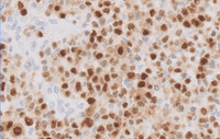 Plasmacytoma-Like PTLD, EBV+ MUM1