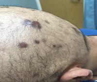 Primary Effusion Lymphoma-Clinical