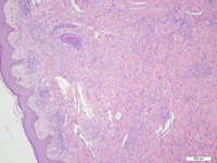 Primary Effusion Lymphoma-H&E