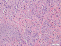 Primary Effusion Lymphoma-H&E High Power