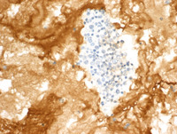 Primary Effusion Lymphoma-Lambda