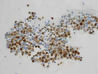 Primary Effusion Lymphoma-MUM1