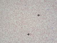 Paroxysmal Nocturnal Hemoglobinuria-Blood